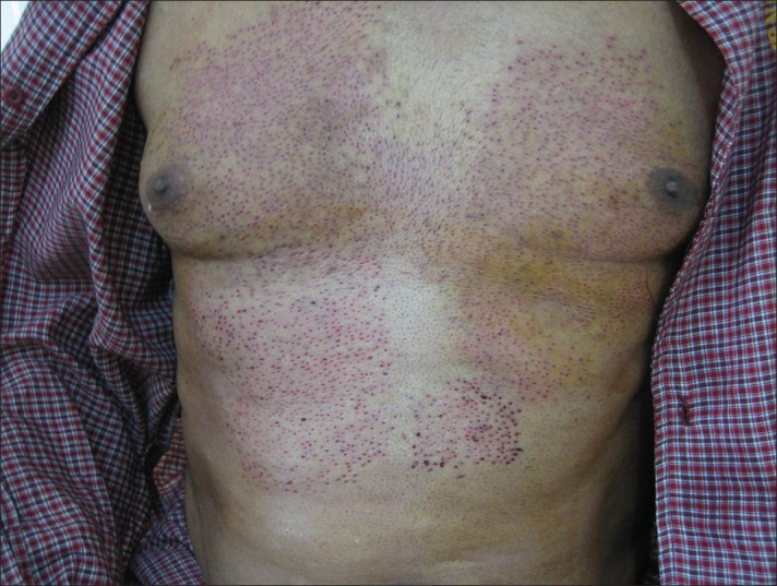 Chest and abdomen after FUE extraction.