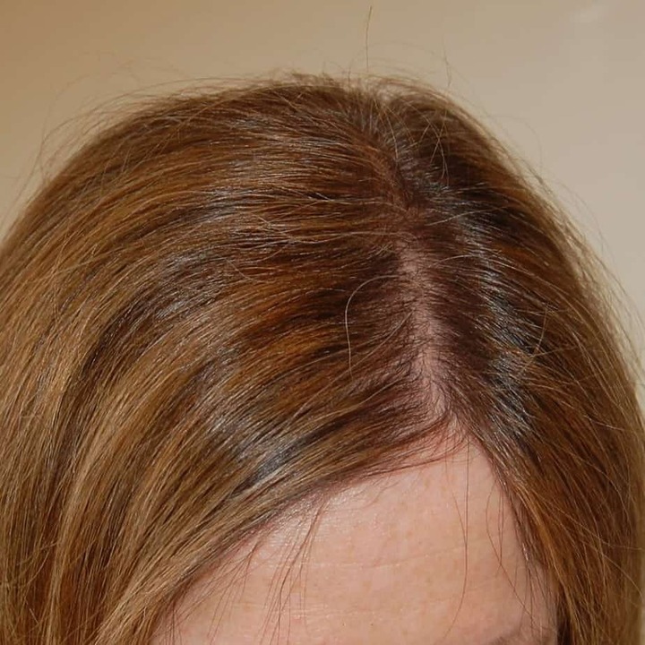 FUE Vs FUT: What’s The Difference? | Wimpole Clinic