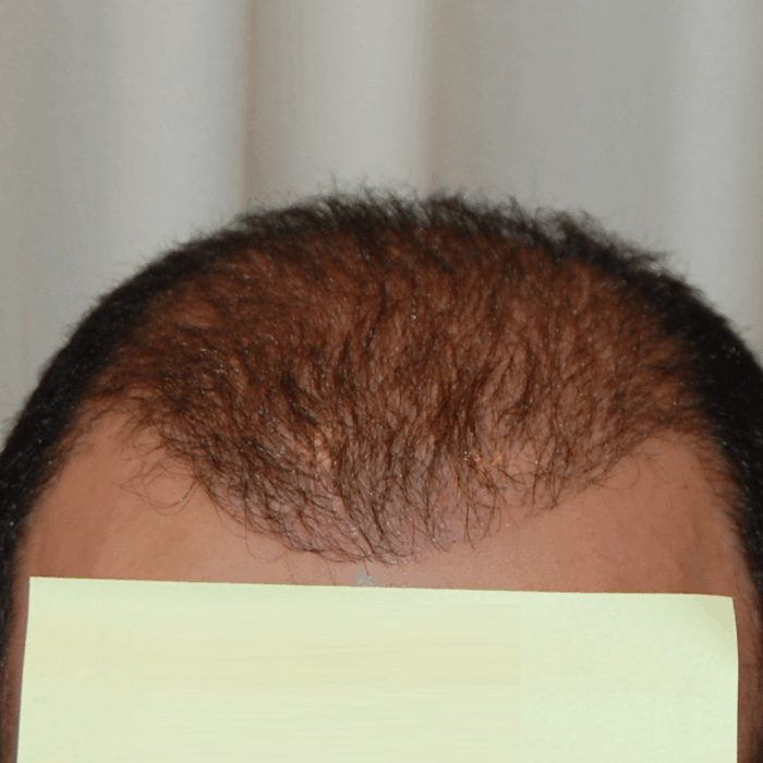 FUE Case Study 2000 grafts into frontal forelock and hairline  Carolina  Hair Surgery