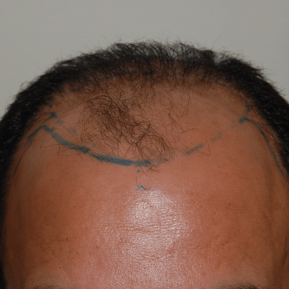 2000 Graft Hair Transplant: Coverage, Results, Costs, Wimpole Clinic