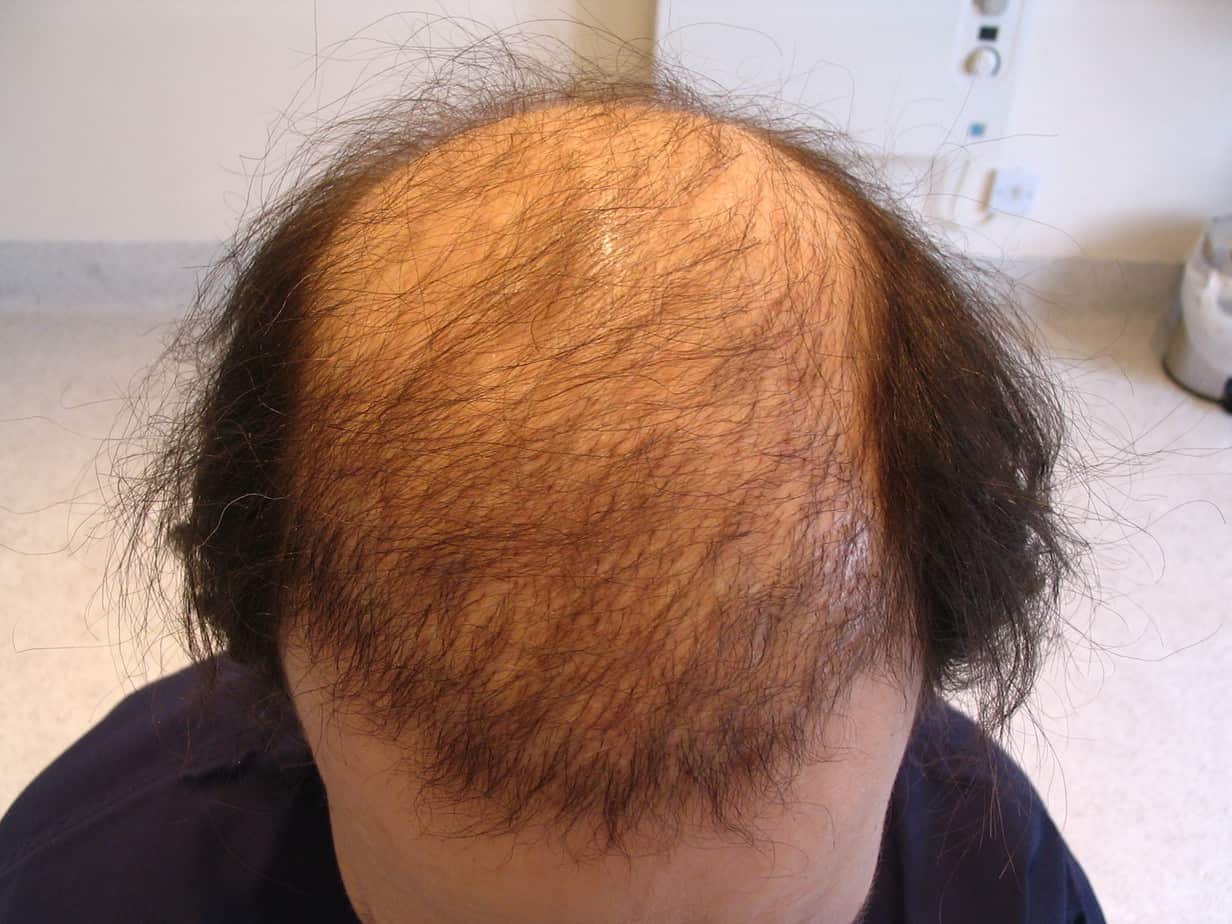 Completely Bald Hair Transplant: Can It Be Done?, Wimpole Clinic