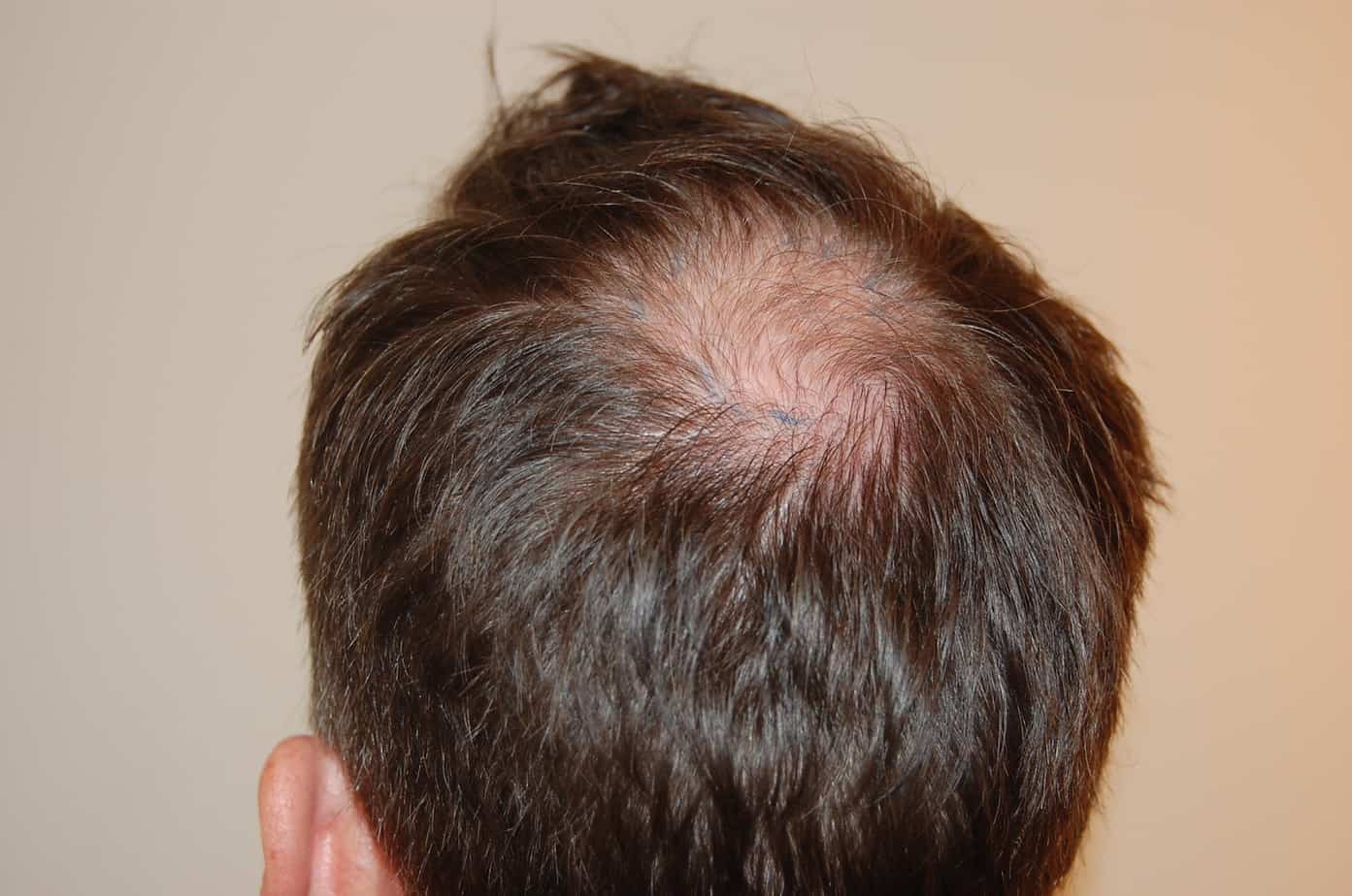 Hair Transplant Close Up: Photos, Videos &#038; Results, Wimpole Clinic