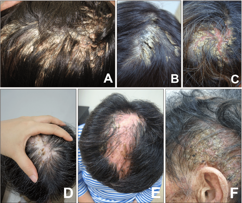 Examples of pityriasis amiantacea in the scalp