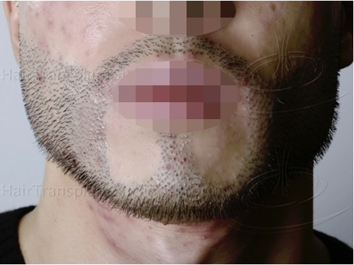 Beard Transplant Gone Wrong? An Expert’s Advice On What To Do Next, Wimpole Clinic