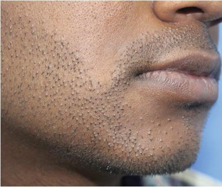 Beard Transplant Gone Wrong? An Expert’s Advice On What To Do Next, Wimpole Clinic