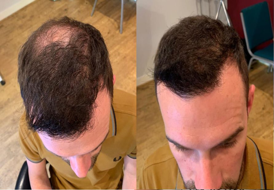 crown hair transplant before and after