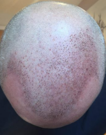 7 days post surgery mid-scalp and frontal D