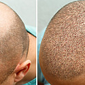 Hair Transplant After 7 Days: Photos, Results & Aftercare