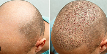 Hair Transplant After 7 Days: Photos, Results & Aftercare - Wimpole Clinic