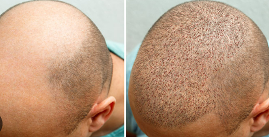 Post Op Recovery Photographs – 2 Weeks After FUE Hair Transplant