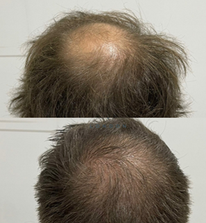 Before and after crown transplant 3 weeks post surgery