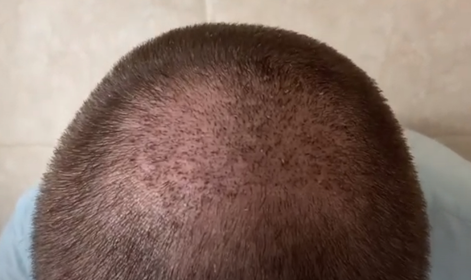 washed scalp 14 days after hair transplant surgery on the crown