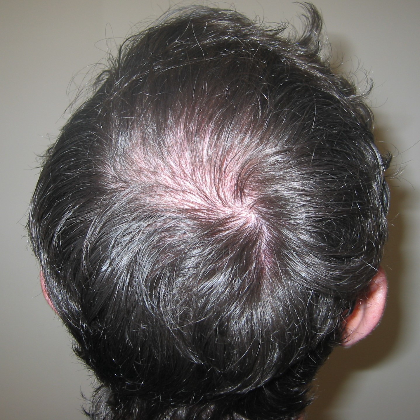 Crown Hair Transplant, Wimpole Clinic