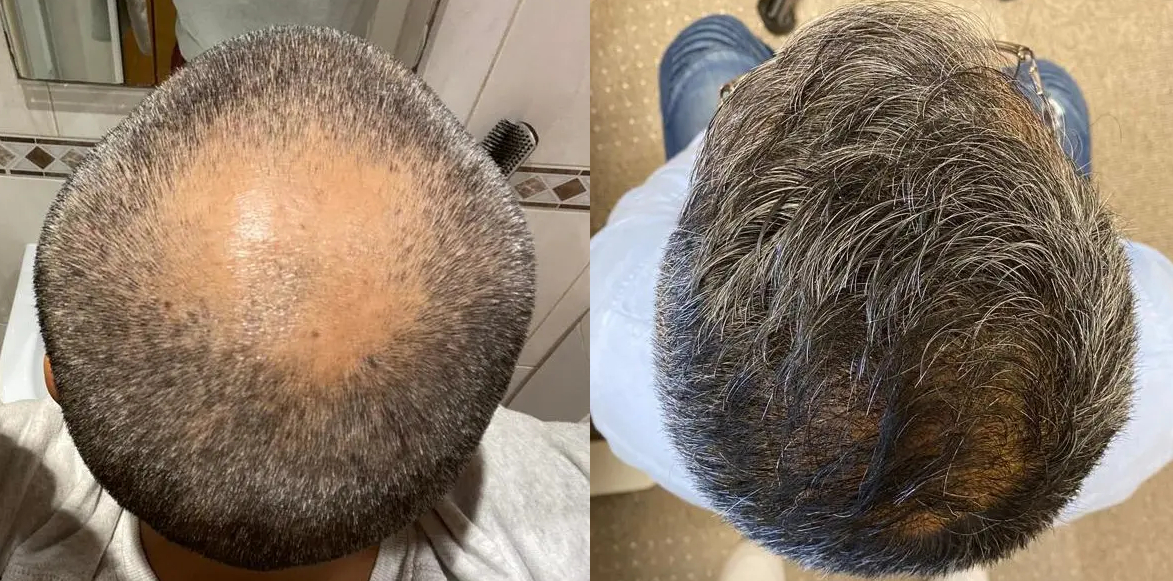 2500 Graft Crown transplant before and after photos