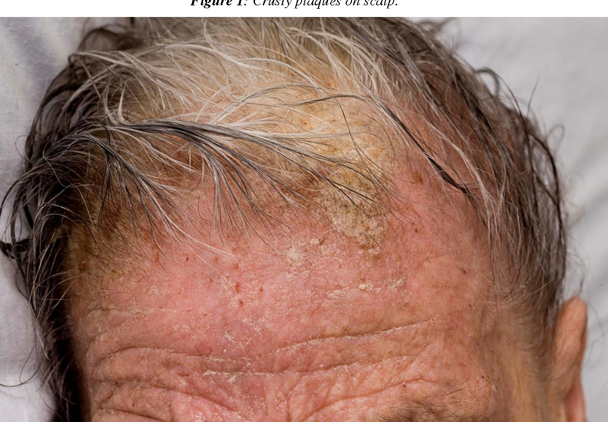 Crusty plaques on the scalp resulting from scabies