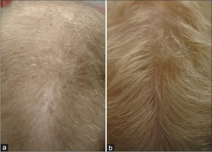 female patient's hair before and after taking Dutasteride