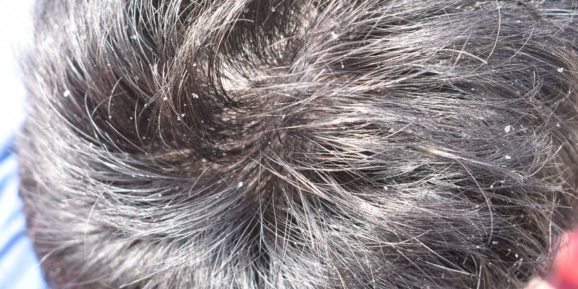 23 Causes Of An Itchy Scalp, According To The NHS