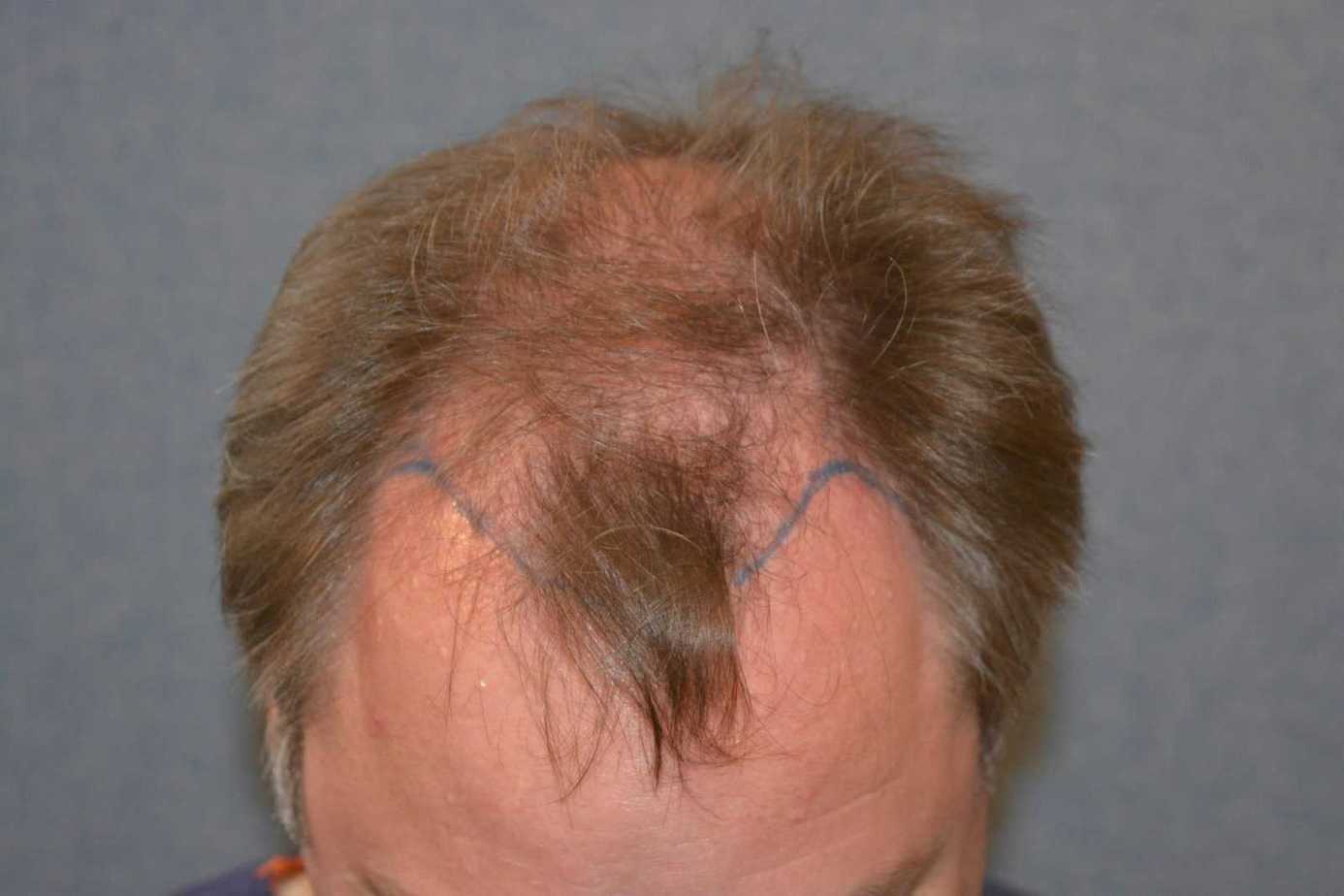 Hair transplant for Wimpole’s Clinic Manager Derek
