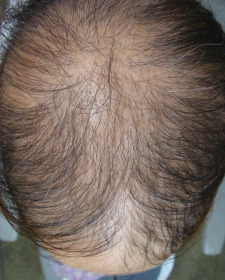 diffuse alopecia areata