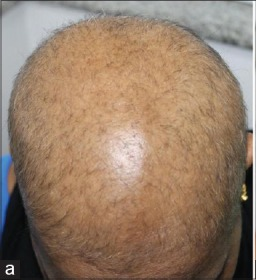 Person with diffuse alopecia areata