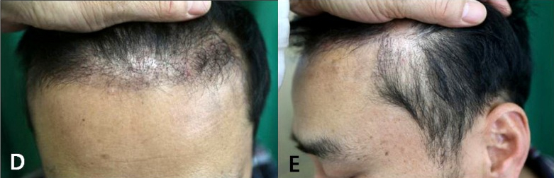 Diffuse hair loss in the frontal and temporal areas post-transplant
