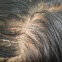 Diffuse Thinning: Signs, Symptoms, And Treatment Options