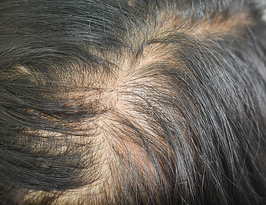 Diffuse-thinning-hair-loss
