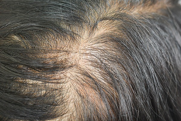Diffuse-thinning-hair-loss