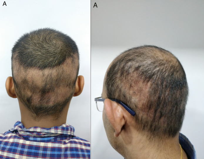 Hair Transplant Shedding: Everything You Need To Know, Wimpole Clinic