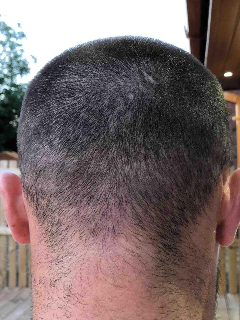 Hair Transplant After 14 Days: Photos, Results, Side Effects, Wimpole Clinic