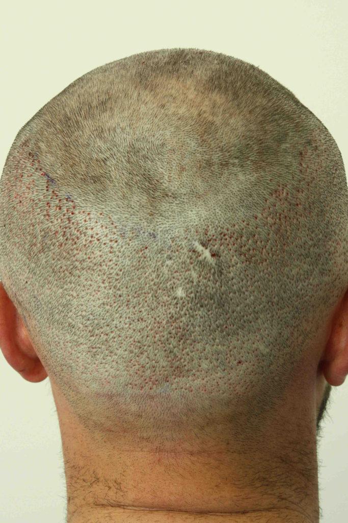 Hair Transplant After 14 Days: Photos, Results, Side Effects, Wimpole Clinic