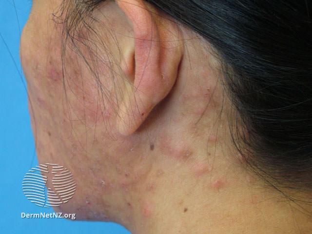 Eosinophilis foliculitis on the neck