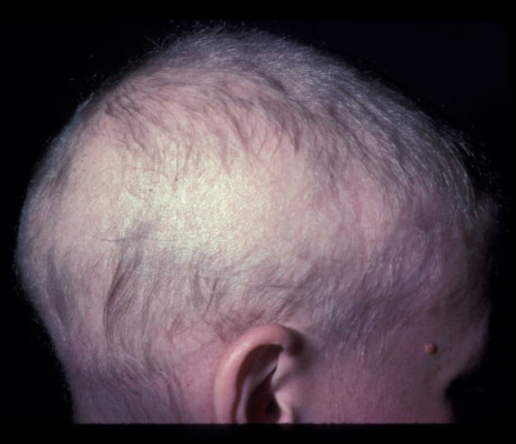 Example of Alopecia totalis