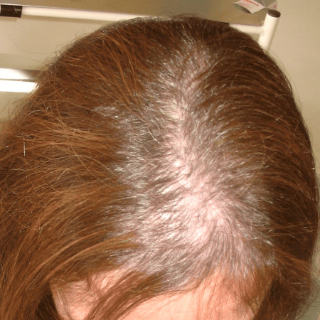 Example of female pattern baldness