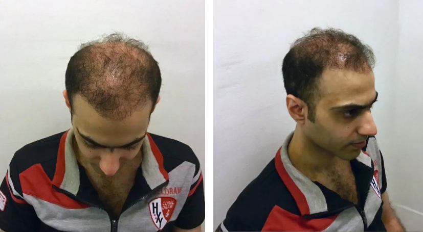 Example of hair transplant gone wrong in Turkey