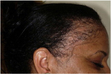 Example of traction alopecia at the temples