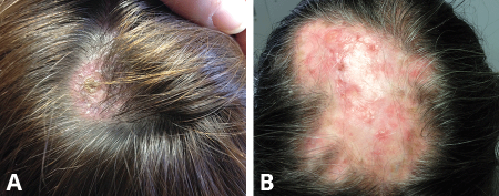 Examples of lupus-related hair loss