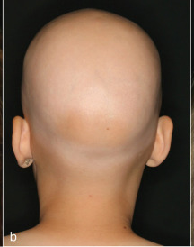 Patient with Alopecia universalis