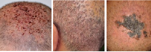 Examples of scalp infection following a hair transplant