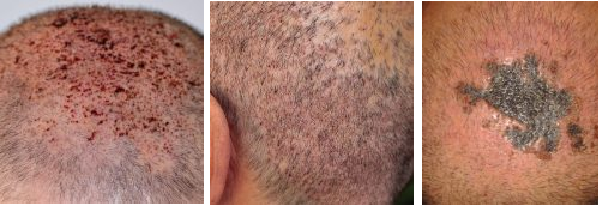 Examples of scalp infections