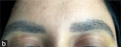 3 weeks post eyebrow transplant surgery
