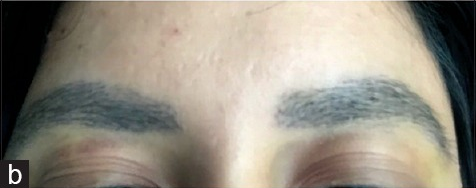 Eyebrow hair restoration 3 weeks after hair transplantation