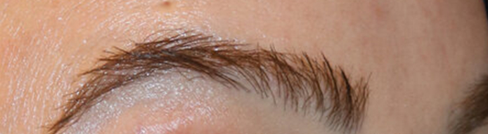 Eyebrow transplant 3 weeks after hair restoration surgery