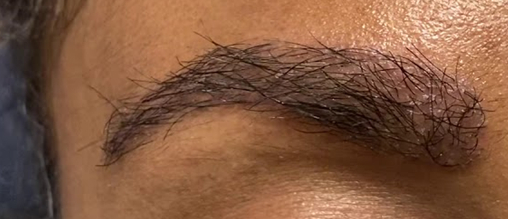 Eyebrow transplant at 3 weeks post-op