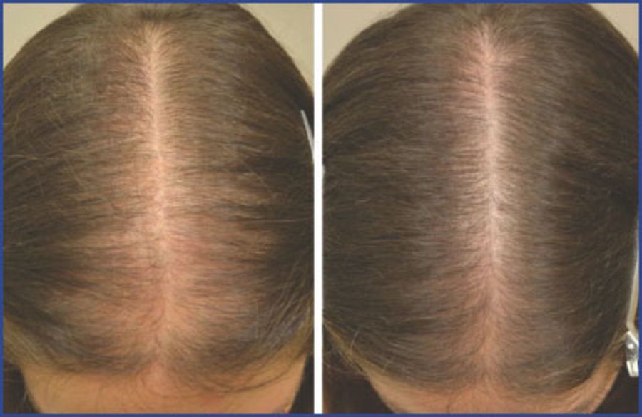 Before and after results of using 5% Minoxidil for 12 months for female androgenic alopecia