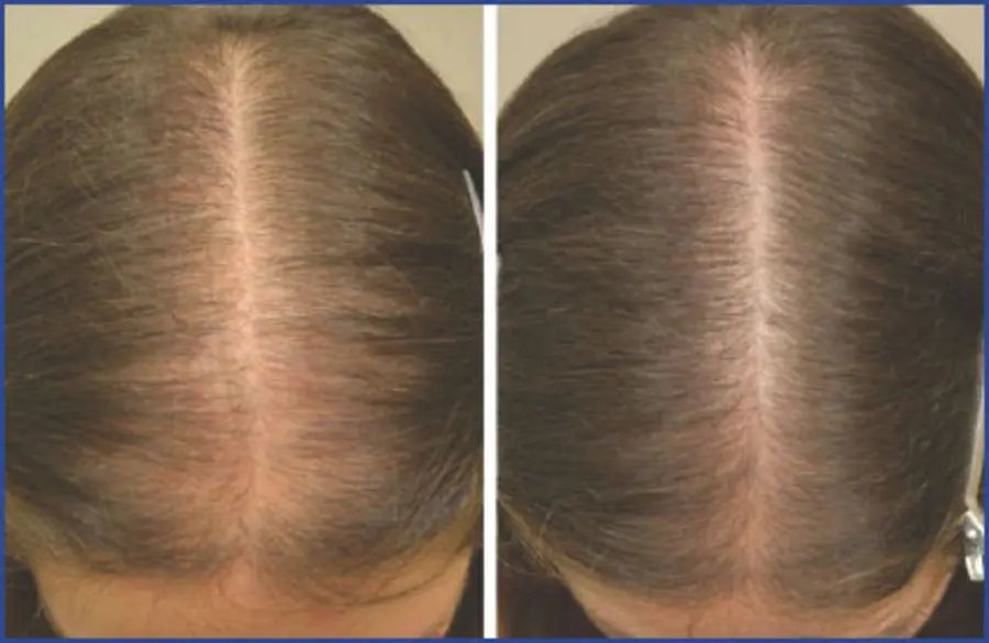 Before and after results of using Minoxidil to treat female pattern baldness