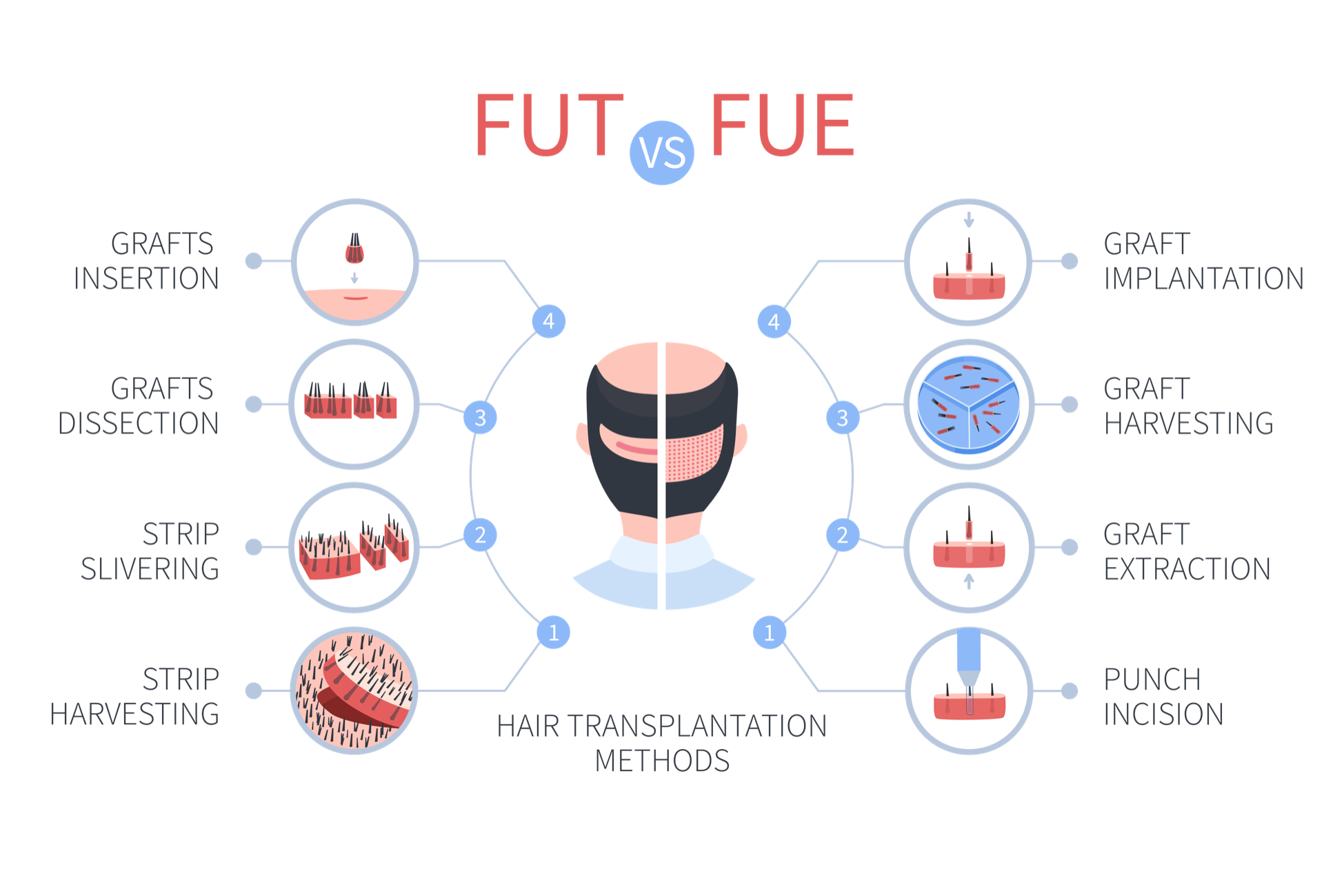 Informational graphic about the difference between the FUT and FUE hair transplant procedures
