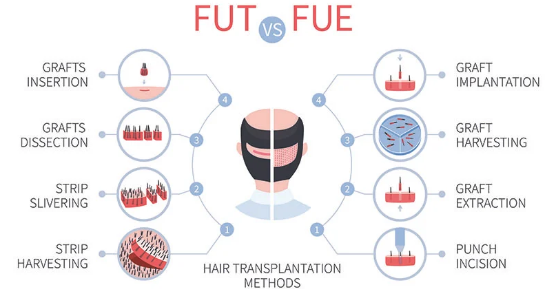 UK Hair Transplants Cost Analysis: Choosing the Right Clinic In 2022, Wimpole Clinic