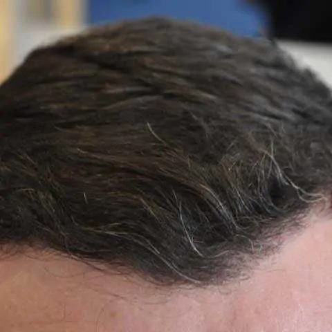 Hairline Transplant, Wimpole Clinic