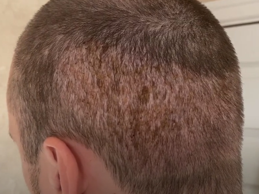 Donor site 14 days after FUE hair transplant